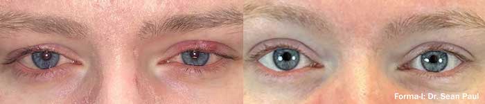 Photos of before and after Envision for Dry Eye Treatment